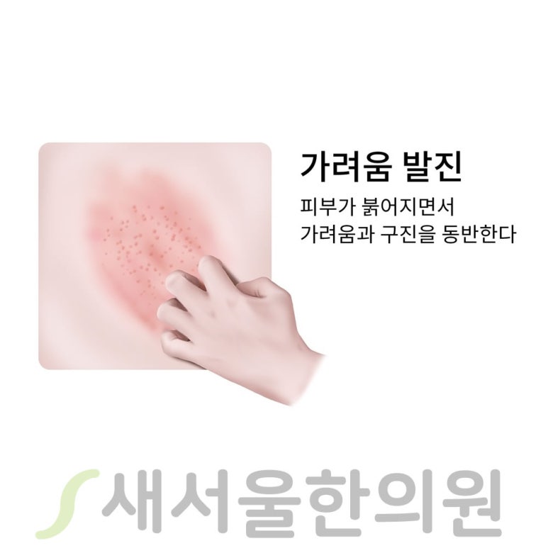 습진 Eczema 증상