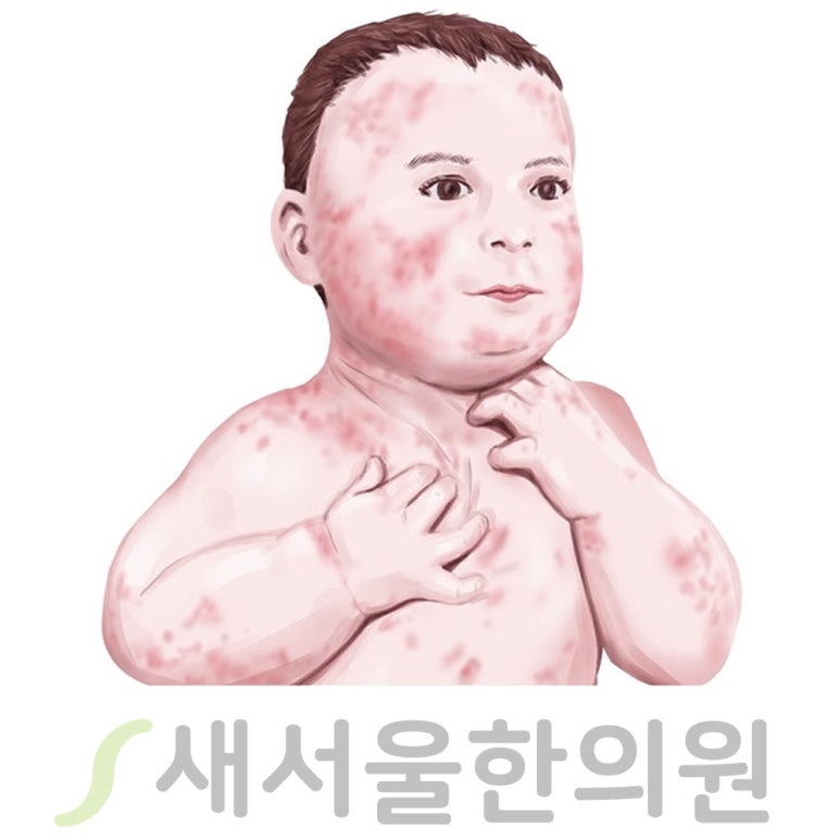 습진 Eczema 종류
