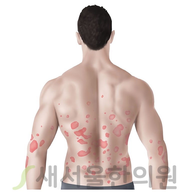 건선 Psoriasis