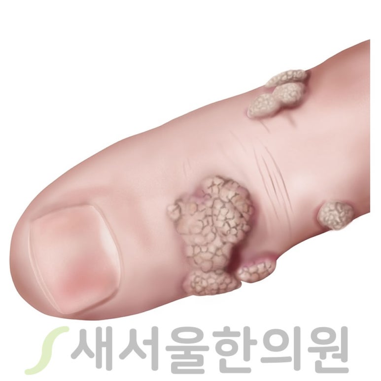 사마귀 疣瘁 Verruca warts
