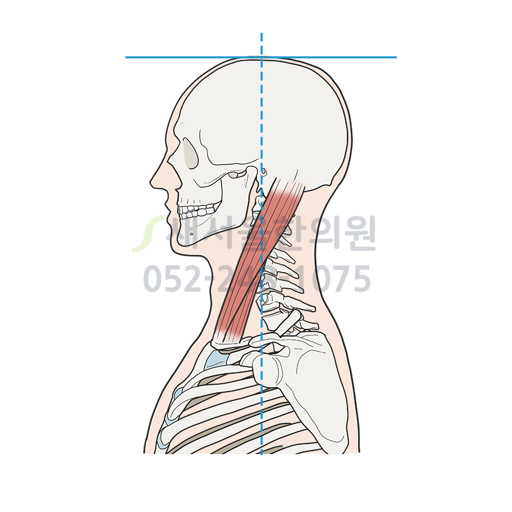 거북목 증후군, 진정한 해법은 어디에 있을까요? (2편: 한의학의 지혜)